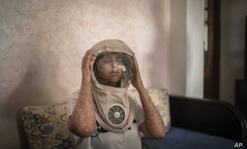 فاطمة الزهراء غزاوي.. “فتاة القمر” التي تخوض معركة التحسيس بمعاناة مرضى جفاف الجلد المصطبغ